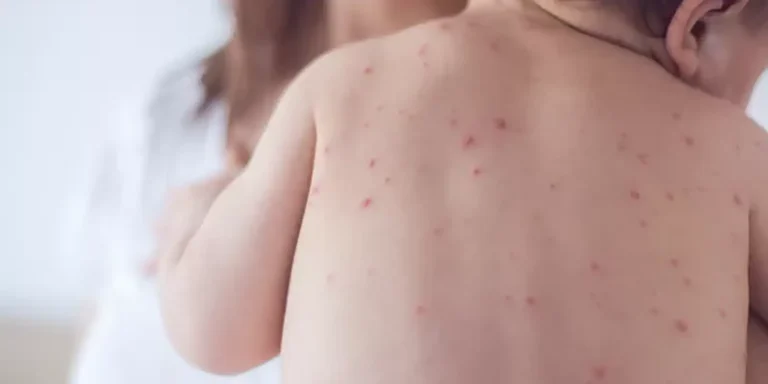 Estado de São Paulo reforça necessidade de vacinação contra o sarampo